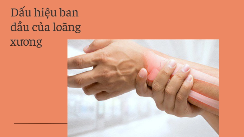 Các biểu hiện sớm của loãng xương 