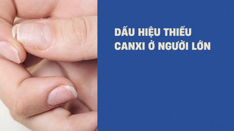 Cách nhận biết dấu hiệu thiếu canxi ở người lớn cực dễ